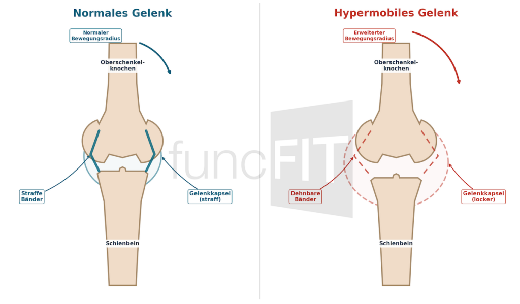 Infografik: Normales vs. hypermobiles Gelenk. Vergleich von Bändern und Gelenkkapsel bei Hypermobilität